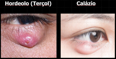 Você sabe o que é Terçol ou Hordéolo E Calázio Entenda as Diferenças