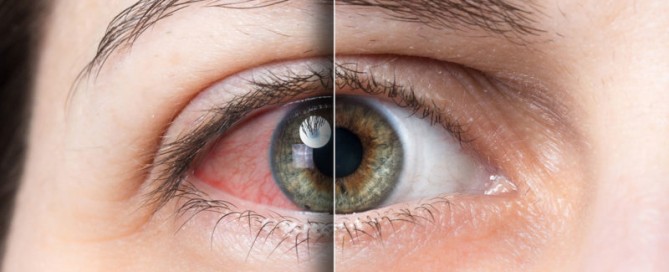 olho seco iatrogênico