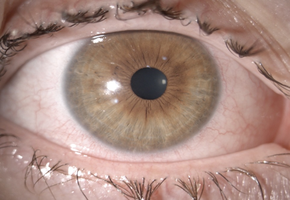 Cristália lança lágrima artificial inovadora para tratar a Síndrome do Olho  Seco