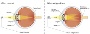 Visão Normal x Astigmatismo