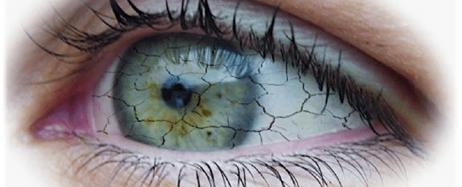 Olho Seco no Brasil