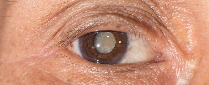 Catarata e Olho Seco