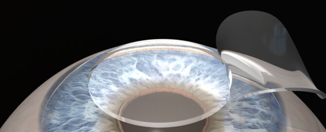 Cirurgia Refrativa e Doença do Olho Seco